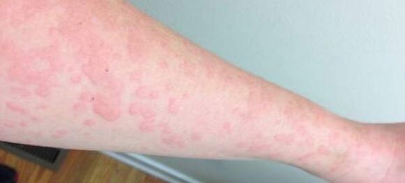 Kožne alergije so znak prisotnosti parazitov v telesu